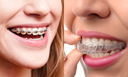 This is the image for the news article titled For The Perfect Smile: Braces Or Invisalign?